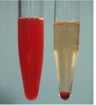 Undersökningar vid blod i urinen